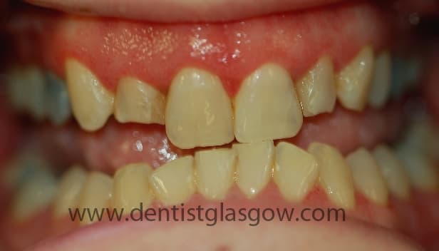 Before Teeth Whitening