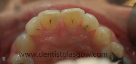 Clearbracesafterpic2