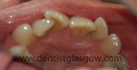 Clearbracesbeforepic