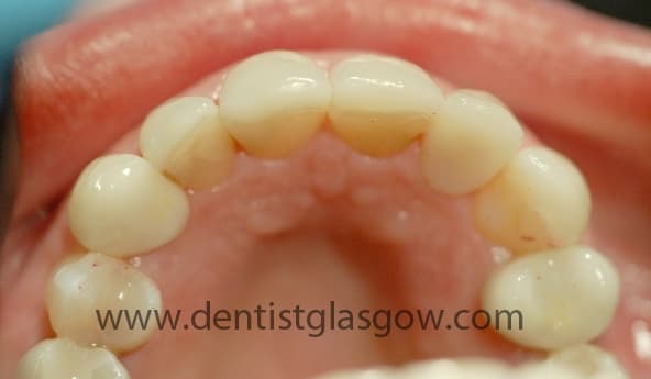Composite White Fillings