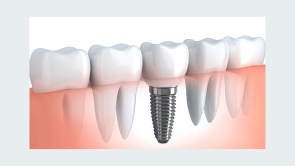 Illustration Of Dental Implant
