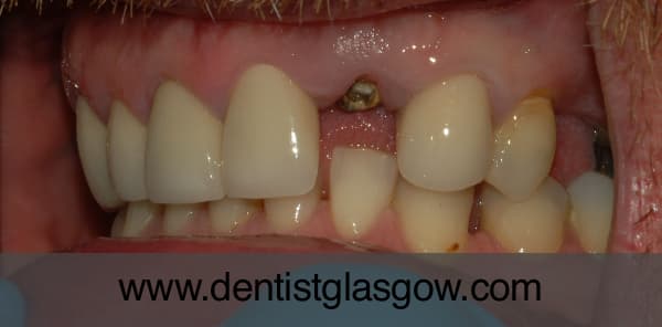 Implant Ready For Crown