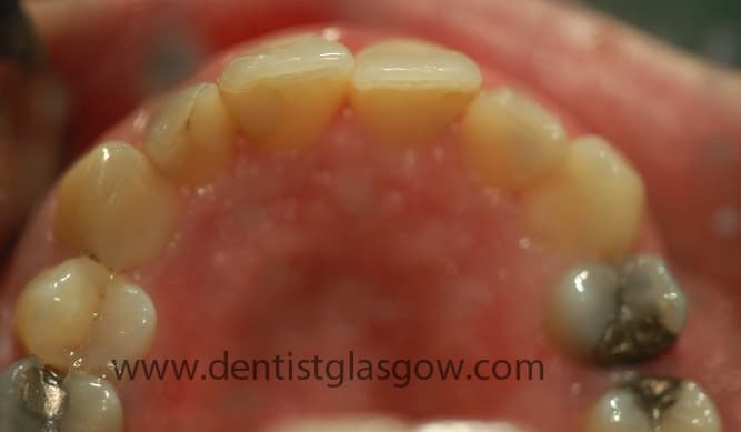 Old Amalgam Fillinga