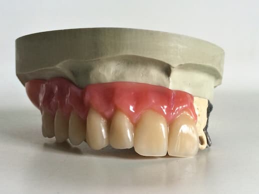Partial Acrylic Denture