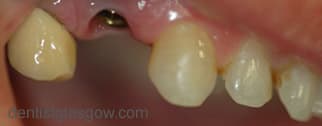 Before Implant Crown And Compoiste Bonding Before Implant Crown And Compoiste Bonding