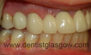 Implant Crown Placed