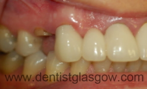 Implant Placed