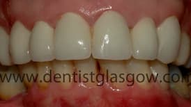 New Porcelain Crowns