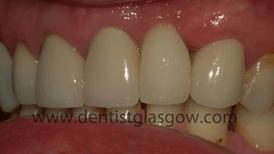 Replaced dental crown