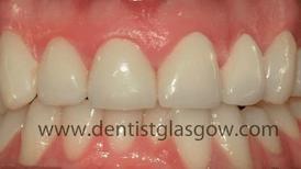 Same day veneers
