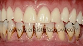 Titanium Bar With Implants
